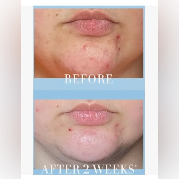 Kate Somerville Eradikate Acne Mark Fading Gel new - Picture 3 of 9